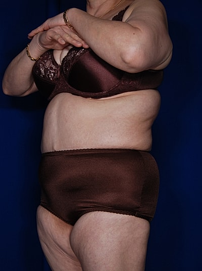 Tummy Tuck Before & After