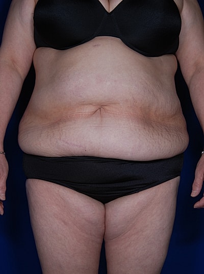 Tummy Tuck Before & After