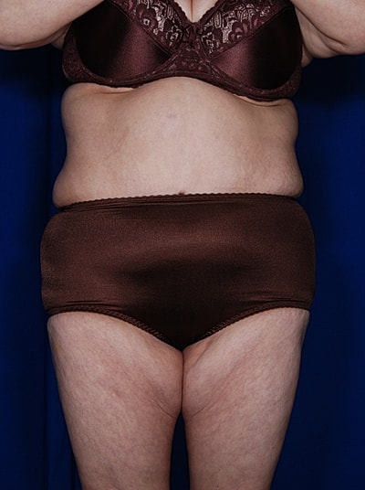 Tummy Tuck Before & After