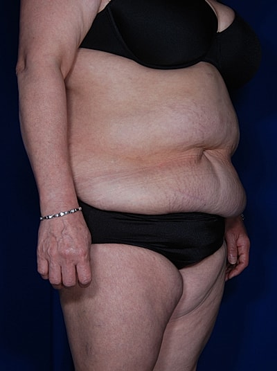 Tummy Tuck Before & After
