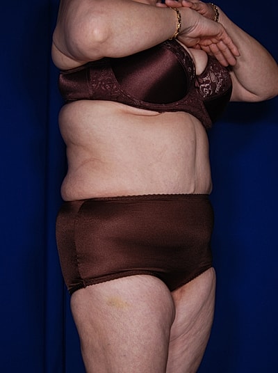Tummy Tuck Before & After