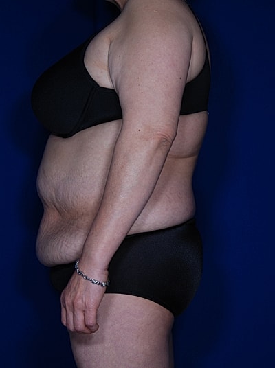 Tummy Tuck Before & After