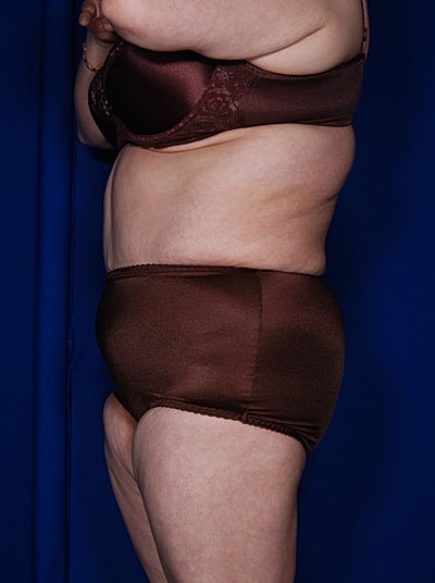 Tummy Tuck Before & After