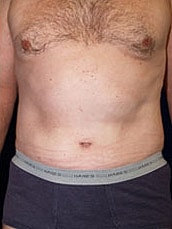 Male Abdominoplasty Before & After