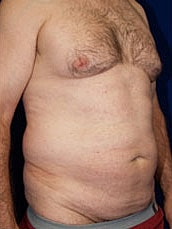 Male Abdominoplasty Before & After