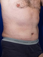 Male Abdominoplasty Before & After