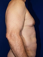 Male Abdominoplasty Before & After