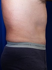 Male Abdominoplasty Before & After