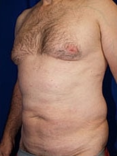 Male Abdominoplasty Before & After