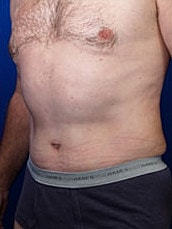 Male Abdominoplasty Before & After