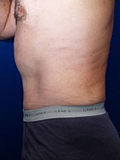 Male Abdominoplasty Before & After