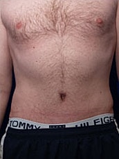 Male Abdominoplasty Before & After