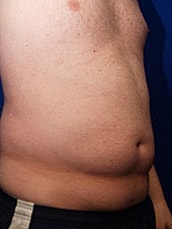 Male Abdominoplasty Before & After