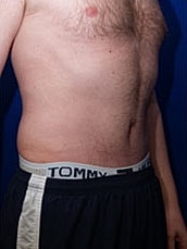 Male Abdominoplasty Before & After
