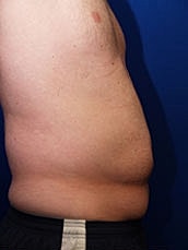 Male Abdominoplasty Before & After