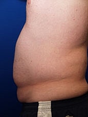 Male Abdominoplasty Before & After