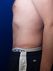 Male Abdominoplasty Before & After