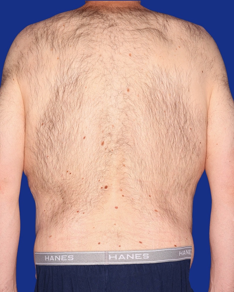 Male Abdominoplasty Before & After