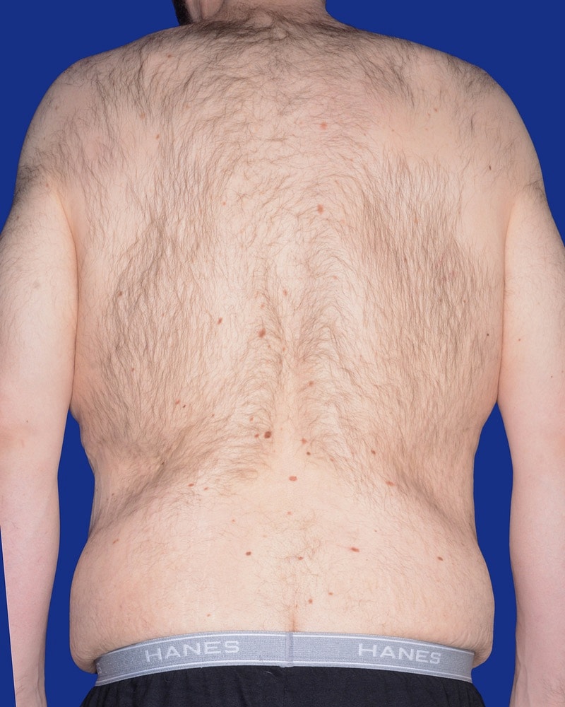 Male Abdominoplasty Before & After