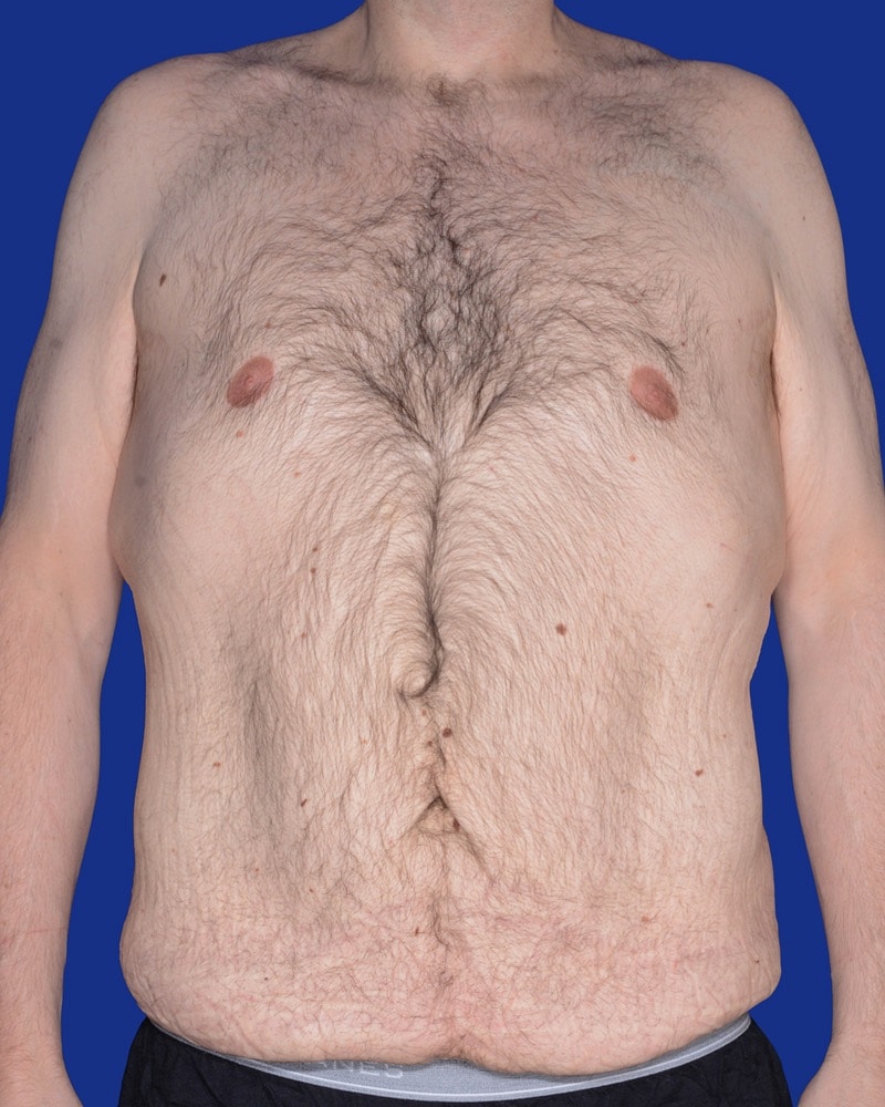 Male Abdominoplasty Before & After