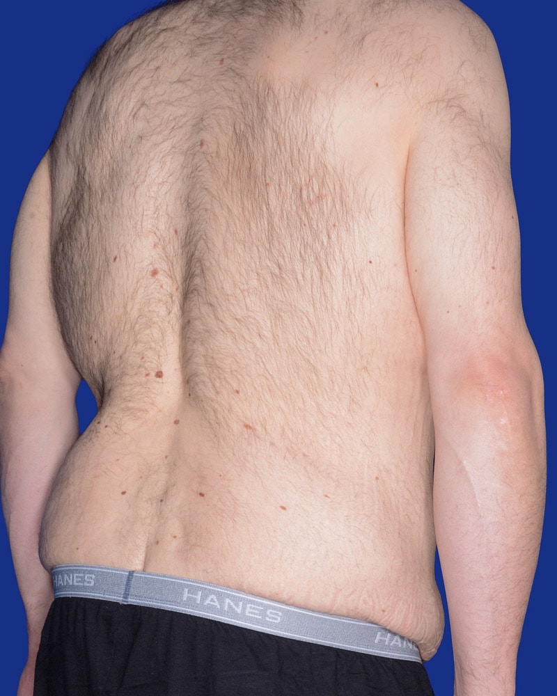 Male Abdominoplasty Before & After