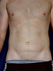 Male Abdominoplasty Before & After