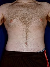 Male Abdominoplasty Before & After