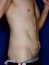Male Abdominoplasty Before & After