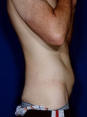 Male Abdominoplasty Before & After