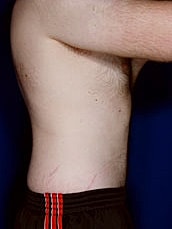 Male Abdominoplasty Before & After
