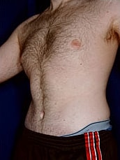 Male Abdominoplasty Before & After