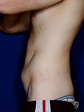 Male Abdominoplasty Before & After