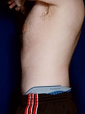 Male Abdominoplasty Before & After
