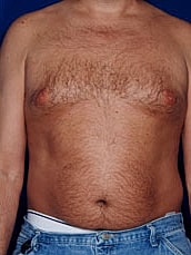 Male Abdominoplasty Before & After