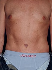 Male Abdominoplasty Before & After