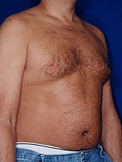 Male Abdominoplasty Before & After