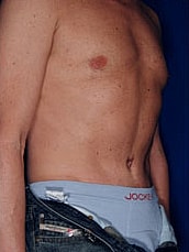 Male Abdominoplasty Before & After
