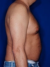 Male Abdominoplasty Before & After