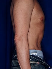 Male Abdominoplasty Before & After