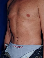 Male Abdominoplasty Before & After
