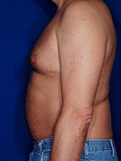 Male Abdominoplasty Before & After