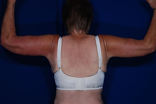 Brachioplasty Before & After
