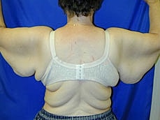 Brachioplasty Before & After