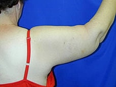 Brachioplasty Before & After