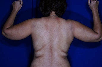 Brachioplasty Before & After