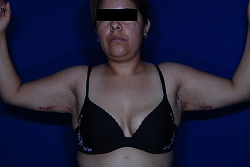 Brachioplasty Before & After