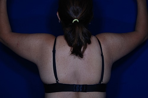 Brachioplasty Before & After