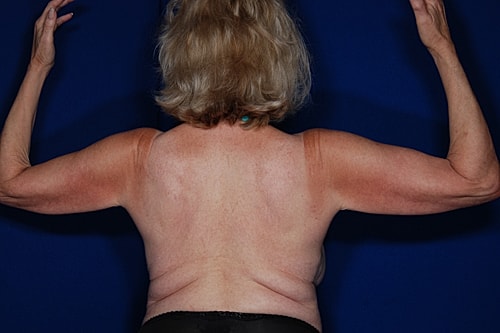 Brachioplasty Before & After
