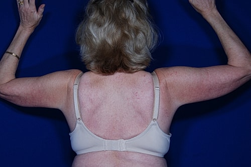 Brachioplasty Before & After