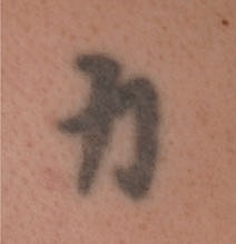 Tattoo Removal Before & After